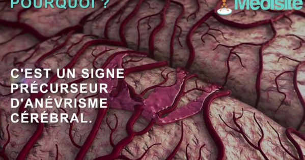 AVC les symptomes qui doivent alerter AVC les symptomes qui doivent alerter