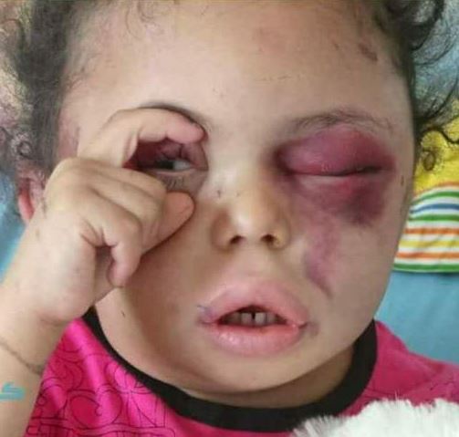 Buthaina, 4 ans, symbole de la guerre civile au Yémen