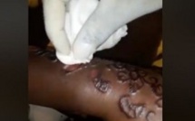 Elle se retrouve à l’hôpital après des séances de tatouages Elle se retrouve à l’hôpital après des séances de tatouages