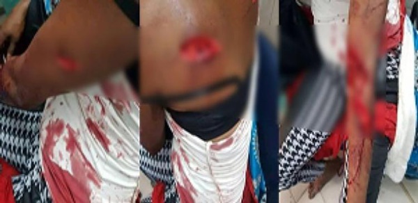 Oumou Diop, charcutée par sa co-épouse, raconte Oumou Diop, charcutée par sa co-épouse, raconte