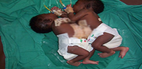 Nécrologie- Décès d’une des soeurs siamoises séparées à l’hôpital Fann Nécrologie- Décès d’une des soeurs siamoises séparées à l’hôpital Fann