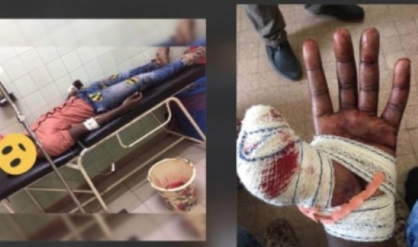 Point E : Le pouce tranché, un homme raconte à SeneWeb son agression à la machette Point E : Le pouce tranché, un homme raconte à SeneWeb son agression à la machette