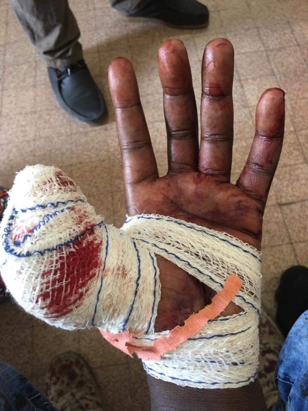 Point E : Le pouce tranché, un homme raconte à SeneWeb son agression à la machette Point E : Le pouce tranché, un homme raconte à SeneWeb son agression à la machette