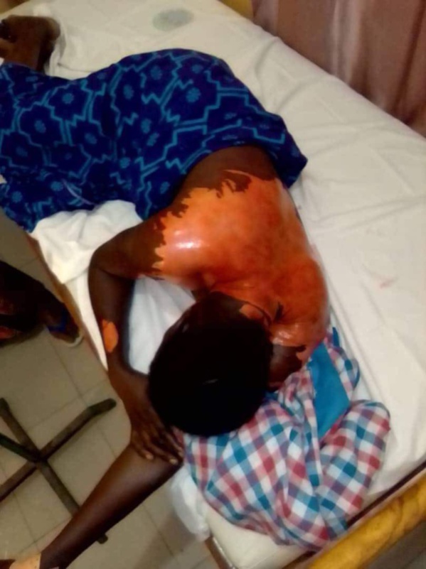 Darou Mousty : Ébouillantée à l’huile par sa coépouse (Awo), elle est menacée de répudiation.
