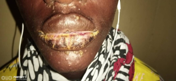 Thiaroye-Sur-Mer: Une mystérieuse maladie sème le trouble dans la localité (Âmes sensibles s'abstenir) Thiaroye-Sur-Mer: Une mystérieuse maladie sème le trouble dans la localité (Âmes sensibles s'abstenir)