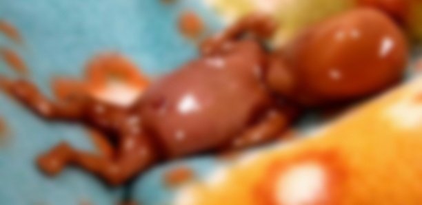 Un fœtus découvert dans un "Ndiaga-Ndiaye" qui fait la navette entre Pikine-Ucad Un fœtus découvert dans un "Ndiaga-Ndiaye" qui fait la navette entre Pikine-Ucad