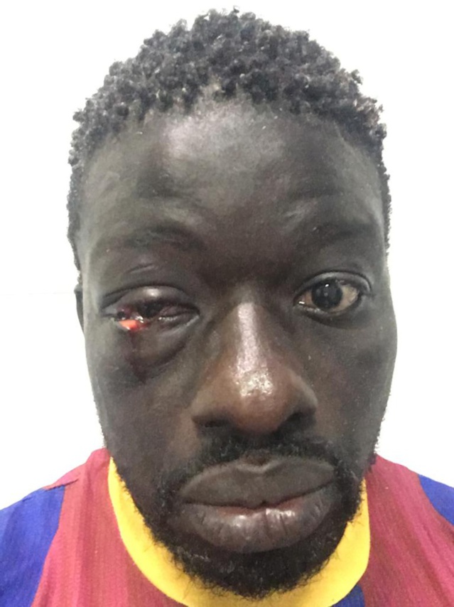 PHOTOS/ Lutte :Zoss, blessé à l’oeil face à Alioune Seye 2 PHOTOS/ Lutte :Zoss, blessé à l’oeil face à Alioune Seye 2