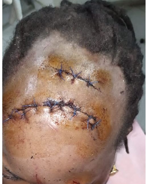 Pour avoir lacéré le visage de Fatou Wade : la militante de Bamba Fall écope d'un an d’emprisonnement dont 6 mois de prison ferme. Pour avoir lacéré le visage de Fatou Wade : la militante de Bamba Fall écope d'un an d’emprisonnement dont 6 mois de prison ferme.
