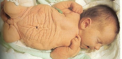 Absence de testicules, infections urinaires… : la double peine des enfants atteints du syndrome de « prune belly » Absence de testicules, infections urinaires… : la double peine des enfants atteints du syndrome de « prune belly »