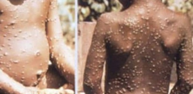 Variole du signe : 1400 cas détectés dans 7 pays africains Variole du signe : 1400 cas détectés dans 7 pays africains