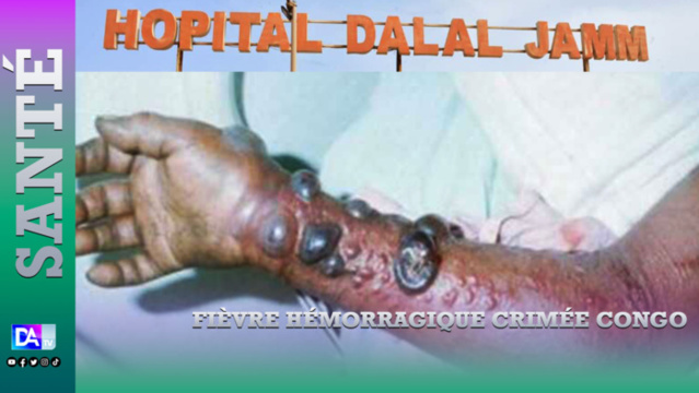 Cas confirmé de la fièvre hémorragique Crimée Congo : Le Sénégal active le COUS Cas confirmé de la fièvre hémorragique Crimée Congo : Le Sénégal active le COUS