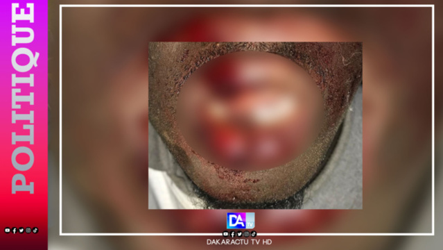 Thiadiaye / La caravane de Pastef attaquée : Un blessé grave et 07 voitures callasées... Une plainte annoncée... Thiadiaye / La caravane de Pastef attaquée : Un blessé grave et 07 voitures callasées... Une plainte annoncée...