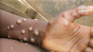 Mpox : la course aux vaccins déjà enclenchée Mpox : la course aux vaccins déjà enclenchée