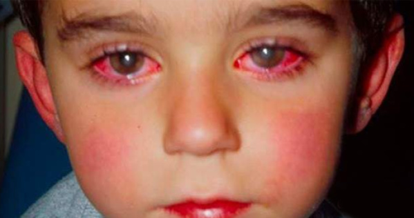 Alerte!  Cet enfant a perdu 75% de sa vue à cause d'un jouet que vous êtes susceptibles d'avoir à la maison