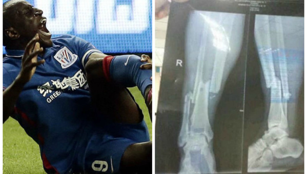 La radio de la jambe cassée de Demba Ba   /   Horrible...Horrible...Horrible...