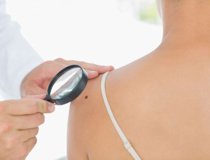 Cancer de la peau : les personnes qui ont peu de grains de beauté sont plus à risque