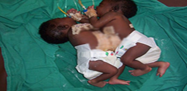 Nécrologie- Décès d’une des soeurs siamoises séparées à l’hôpital Fann