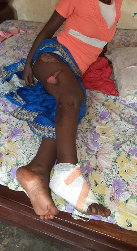 Guinée : une jeune domestique accusée de vol par sa patronne, brûlée à l’aide d’un fer à repasser (images sensibles)