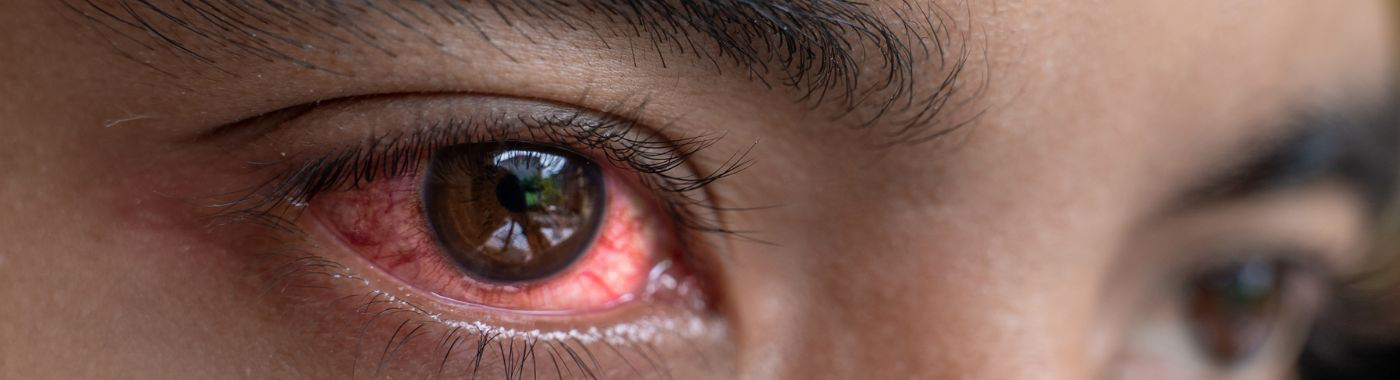 Yeux rouges : face au risque de propagation, les spécialistes appellent à une vigilance accrue et au respect des règles d’hygiène