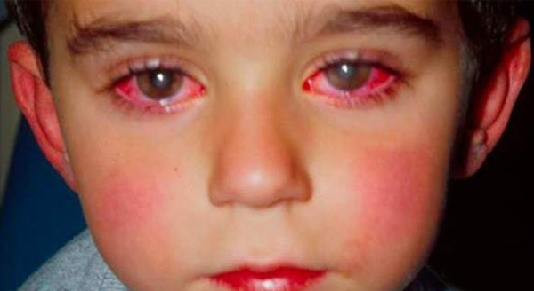 Alerte!  Cet enfant a perdu 75% de sa vue à cause d'un jouet que vous êtes susceptibles d'avoir à la maison