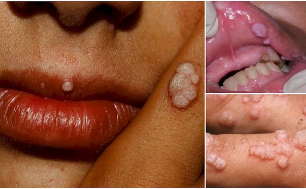 Attention!  Une nouvelle maladie mortelle pire que le Sida (VIH)