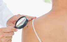 Cancer de la peau : les personnes qui ont peu de grains de beauté sont plus à risque