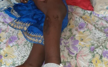 Guinée : une jeune domestique accusée de vol par sa patronne, brûlée à l’aide d’un fer à repasser (images sensibles)