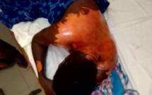 Darou Mousty : Ébouillantée à l’huile par sa coépouse (Awo), elle est menacée de répudiation.