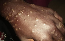 VIDEO/ Maladie dermique: Les Lébous s'inquiètent de leur devenir et demandent aux autorités de faire de sérieuses analyses du produit