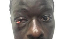 PHOTOS/ Lutte :Zoss, blessé à l’oeil face à Alioune Seye 2