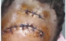 Pour avoir lacéré le visage de Fatou Wade : la militante de Bamba Fall écope d'un an d’emprisonnement dont 6 mois de prison ferme.