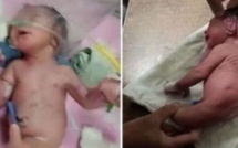 Un bébé né avec une corne étrange au lieu de jambes, laisse les médecins perplexes