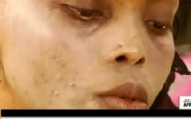 Les dangers des crèmes blanchissantes, Le Xessal Fait des ravages chez les noirs Les dangers des crèmes blanchissantes, Le Xessal Fait des ravages chez les noirs