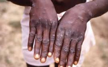 Mpox en RD Congo : les prostituées durement touchées par l'épidémie