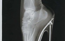 Un pied dans une chaussure à talon….Le tout passé au rayon X .