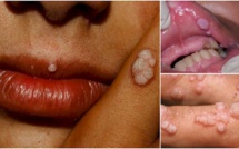 Attention!  Une nouvelle maladie mortelle pire que le Sida (VIH)