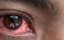 Yeux rouges : face au risque de propagation, les spécialistes appellent à une vigilance accrue et au respect des règles d’hygiène