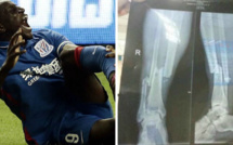 La radio de la jambe cassée de Demba Ba   /   Horrible...Horrible...Horrible... La radio de la jambe cassée de Demba Ba   /   Horrible...Horrible...Horrible...